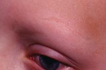 Alopecia totalis eyebrow